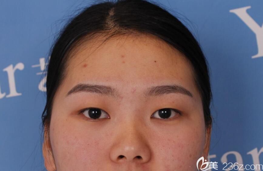 去合肥艺星整形找孙洋做眼综合前 去合肥艺星整形找孙洋做眼综合前