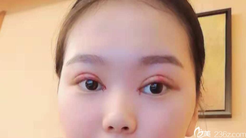 眼综合手术第2天去艺星整形医院换药 眼综合手术第2天去艺星整形医院换药