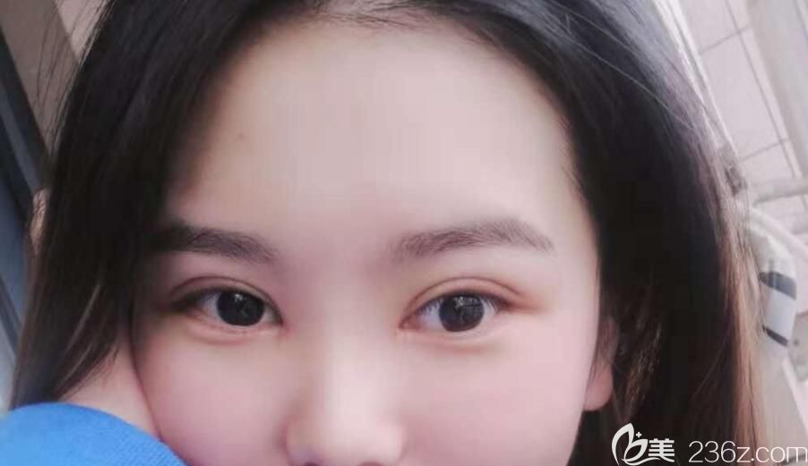 合肥艺星整形割双眼皮+开内眼角眼综合术后第9天 合肥艺星整形割双眼皮+开内眼角眼综合术后第9天