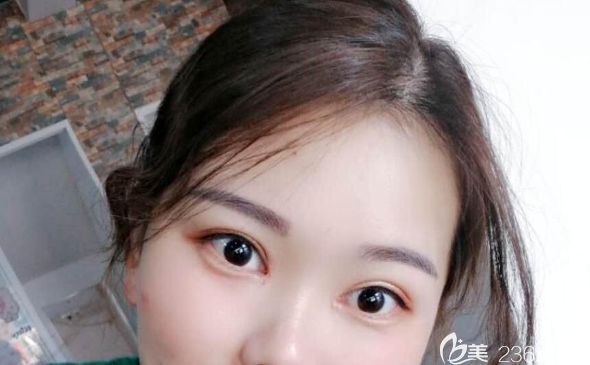 艺星整形眼综合术后第26天恢复情况 艺星整形眼综合术后第26天恢复情况