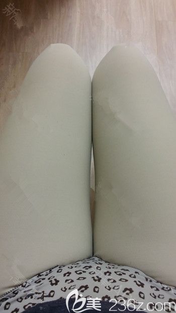 在韩国35mc做吸脂手术后2周 在韩国35mc做吸脂手术后2周