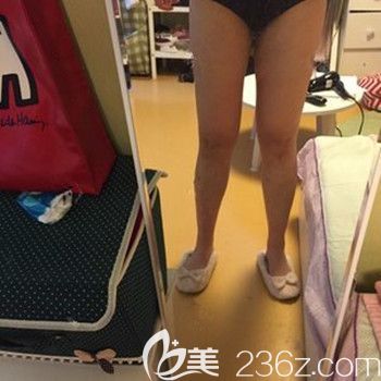 在韩国35mc做吸脂手术后40天 在韩国35mc做吸脂手术后40天