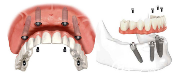 all-on-4种植牙原理示意图片 all-on-4种植牙原理示意图片