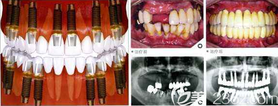 全口传统种植牙前后效果对比示意图 全口传统种植牙前后效果对比示意图