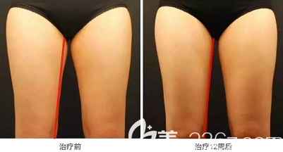 北京艺星酷塑冷冻减脂瘦大腿案例