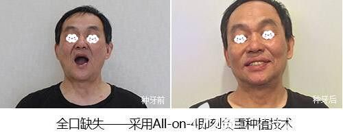 全口种植牙ALL-ON-4即刻种植案例前后效果对比图 全口种植牙ALL-ON-4即刻种植案例前后效果对比图