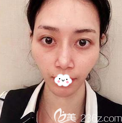 在广州星团医美做脂肪填充术前照片 在广州星团医美做脂肪填充术前照片