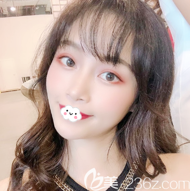 广州星团医美脂肪填充全脸一个月效果图 广州星团医美脂肪填充全脸一个月效果图