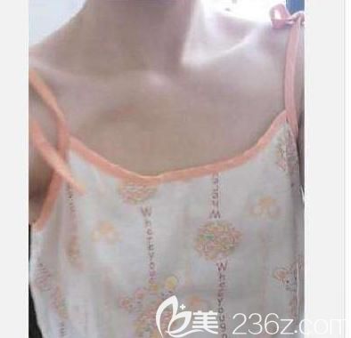 当天就约了自体脂肪丰胸 当天就约了自体脂肪丰胸