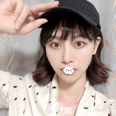 全脸自体脂肪填充三个月恢复过程图 全脸自体脂肪填充三个月恢复过程图