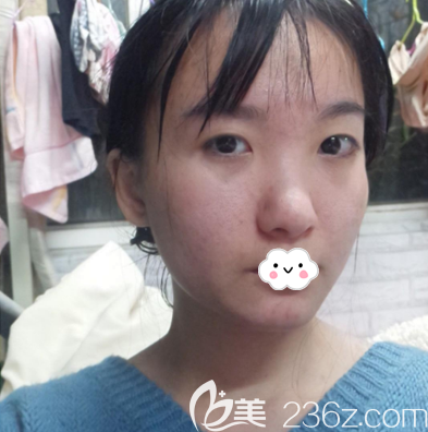 在深圳润泽瑞尼丝做双眼皮隆鼻术前照片 在深圳润泽瑞尼丝做双眼皮隆鼻术前照片