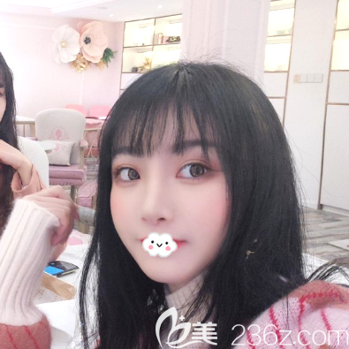 双眼皮隆鼻术后15天恢复效果图 双眼皮隆鼻术后15天恢复效果图