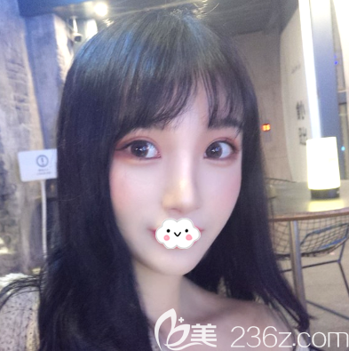 深圳润泽瑞尼丝双眼皮隆鼻案例一个月效果图 深圳润泽瑞尼丝双眼皮隆鼻案例一个月效果图