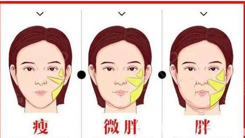 面部吸脂适合什么人