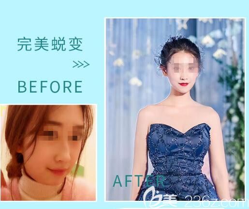 郑州菲林面部吸脂案例