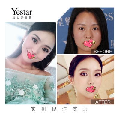 合肥艺星整形耿继龙美杜莎眼综合+鼻综合+瘦脸案例前后效果对比图 合肥艺星整形耿继龙美杜莎眼综合+鼻综合+瘦脸案例前后效果对比图