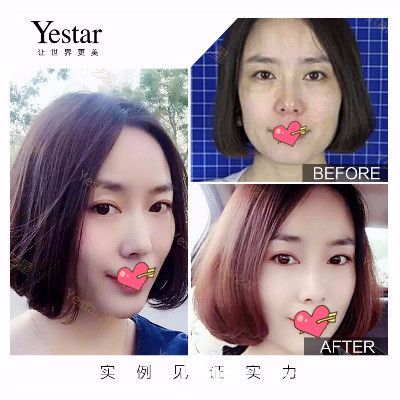 合肥艺星整形邵辉全脸埋线提升案例 合肥艺星整形邵辉全脸埋线提升案例