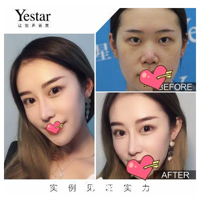 合肥艺星孙洋手术怎么样?孙洋院长鼻综合+眼综合案例来验证 合肥艺星孙洋手术怎么样?孙洋院长鼻综合+眼综合案例来验证