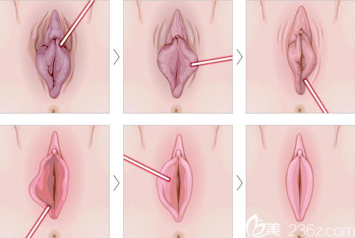激光小阴唇整形 激光小阴唇整形
