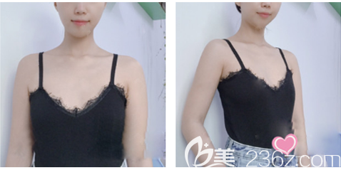 在深圳润泽瑞尼丝做隆胸术前照片 在深圳润泽瑞尼丝做隆胸术前照片