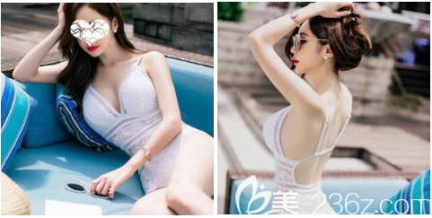 深圳润泽瑞尼丝刘庚自体脂肪隆胸案例 深圳润泽瑞尼丝刘庚自体脂肪隆胸案例