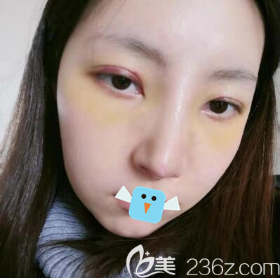 成都向朝肋软骨隆鼻拆线后效果