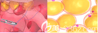 北京禾美嘉吸脂手术示意图 北京禾美嘉吸脂手术示意图