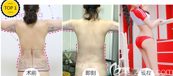 北京禾美嘉任学会医生腰腹吸脂+手臂吸脂案例