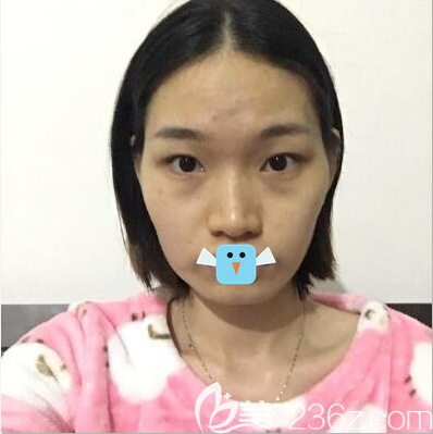 颧骨颧弓下颌角整形前照片 颧骨颧弓下颌角整形前照片