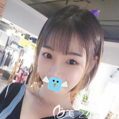 四川友谊医院李继华颧骨颧弓+下颌角整形术后效果图 四川友谊医院李继华颧骨颧弓+下颌角整形术后效果图