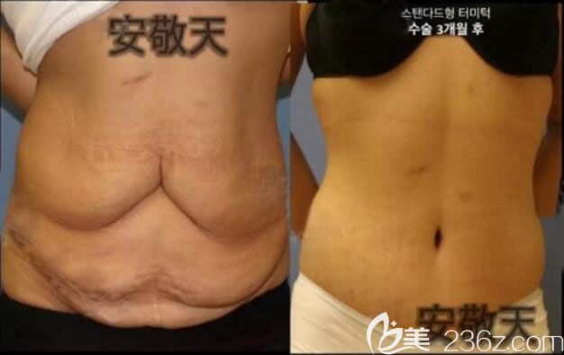 韩国纯真安敬天院长腰腹吸脂案例术前术后效果对比图