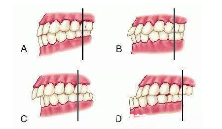牙性和骨性龅牙对比照