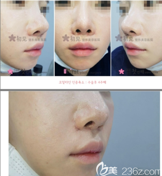 人中长太凶韩国初见first整形赵庸佑人中缩短让我看起来和善年轻多了