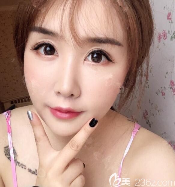 韩国初见first整形做人中缩短怎么样 韩国初见first整形做人中缩短怎么样