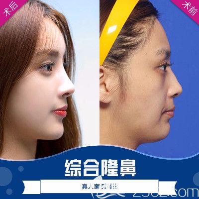 广州荔医整形医院张勇做隆鼻怎么样 广州荔医整形医院张勇做隆鼻怎么样