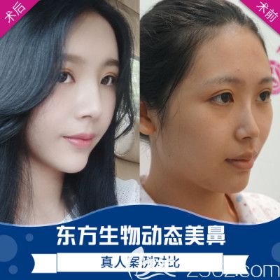 广州荔医张勇做的隆鼻失败修复和肋软骨隆鼻案例 广州荔医张勇做的隆鼻失败修复和肋软骨隆鼻案例