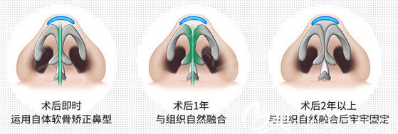 广州荔医张勇医生拱形支架隆鼻技术 广州荔医张勇医生拱形支架隆鼻技术