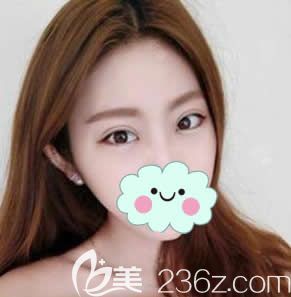 全切双眼皮和开眼角30天效果图片