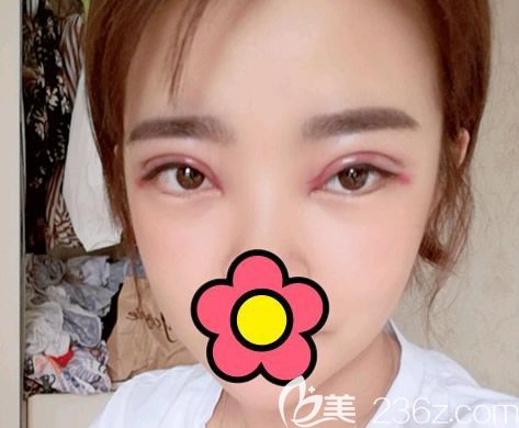 呼市五洲整形王焕全切双眼皮7mm第1天图片
