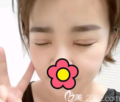 切开双眼皮第5天的闭眼照