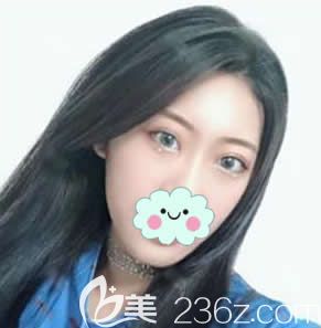 台州艺星阮凯做双眼皮案例