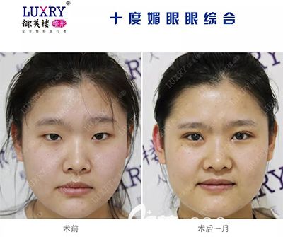 鸡西御美楼双眼皮效果对比