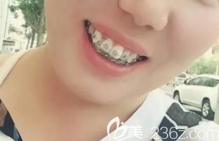 在昆明德韩口腔做牙齿矫正刚戴牙套