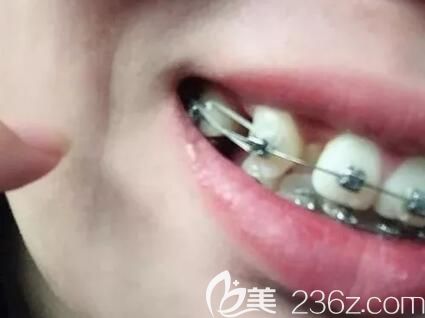 我在昆明德韩口腔做牙齿矫正45天带皮筋