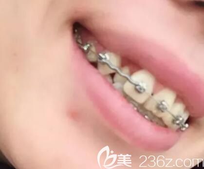 我在昆明德韩口腔戴牙套第4个月