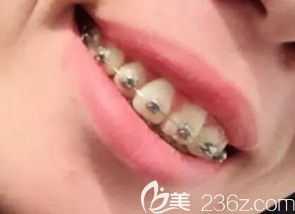 我在昆明德韩口腔做自锁托槽矫正第6个月