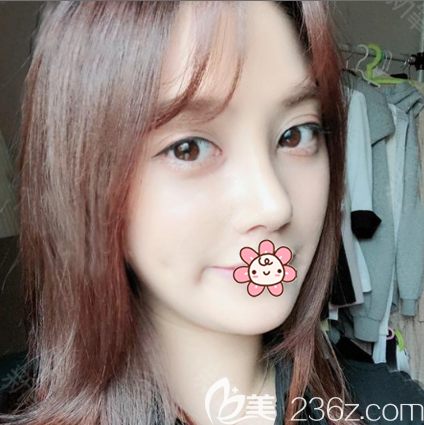 看我找广州荔医李增产做的双眼皮隆鼻怎么样