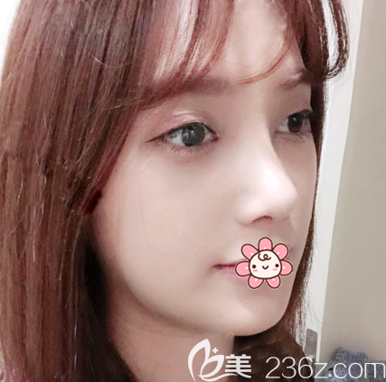 双眼皮隆鼻术后10天效果图