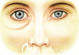眼袋示意图