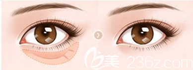 祛眼袋前后效果对比图